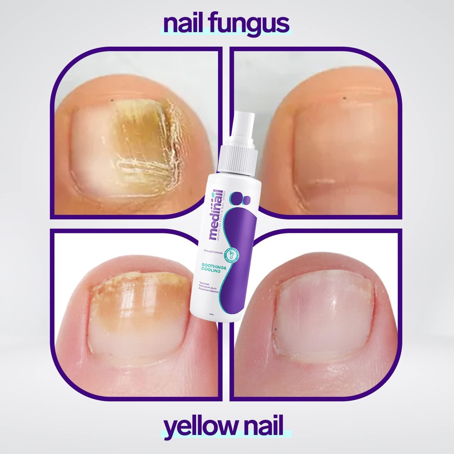 Jaysuin - Nail Fungus Spray